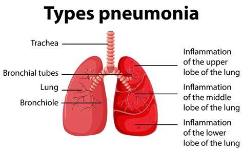 medical name for pneumonia