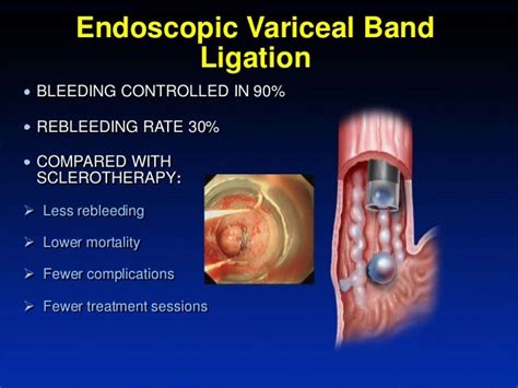 medical term band ligation