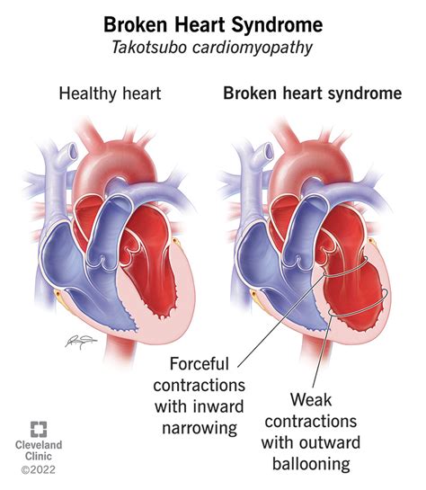 medical term for broken heart syndrome