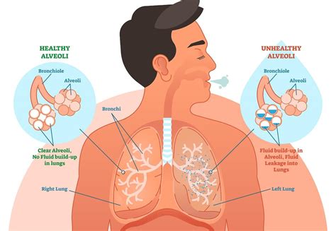 Medication Fluid On Lungs