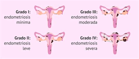 medidas del endometrio en menopausia