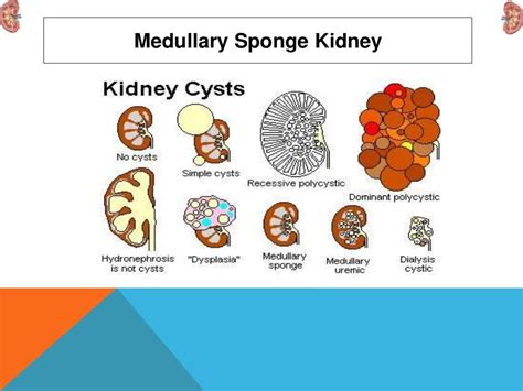 Understanding Medullary Sponge Kidney: Causes, Symptoms, and Treatment Options