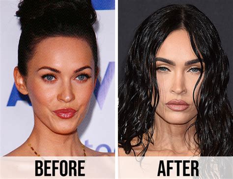 megan fox forehead reduction