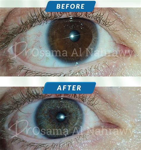 Melanin in the Iris