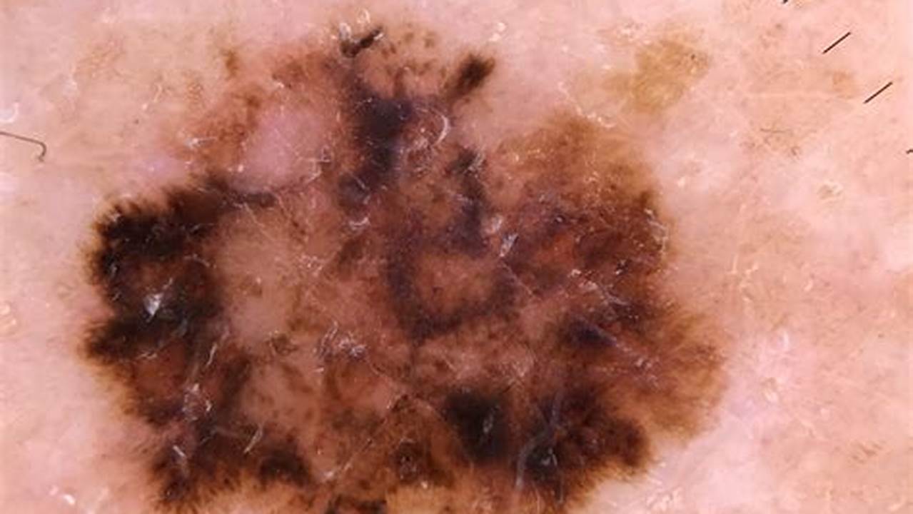 Spot Melanoma Early: A Guide to Interpreting Melanoma Skin Cancer Pictures