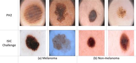 melanoma and non melanoma