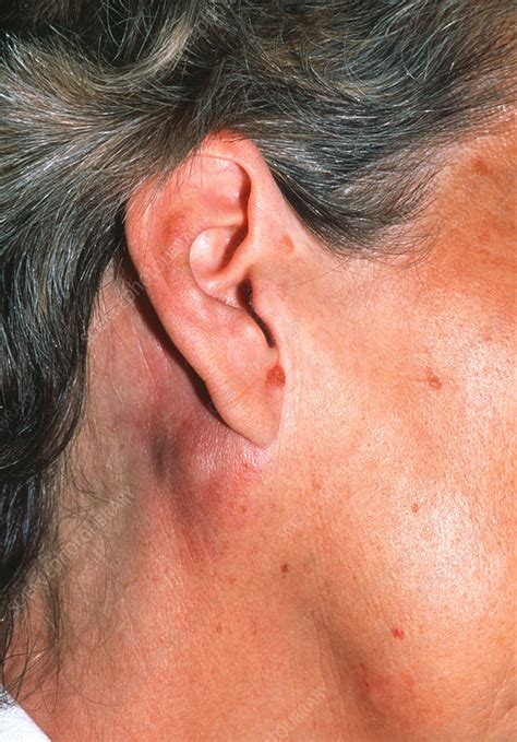 melanoma and swollen lymph nodes