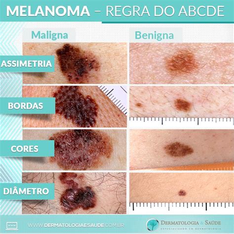 melanoma benigno o maligno