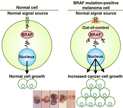 melanoma braf mutation treatment