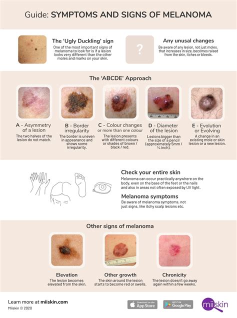 melanoma cancer symptoms