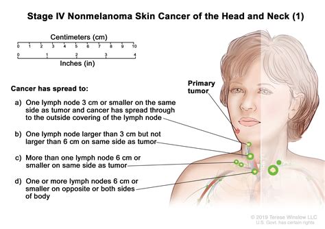 melanoma cancer symptoms and lymph nodes