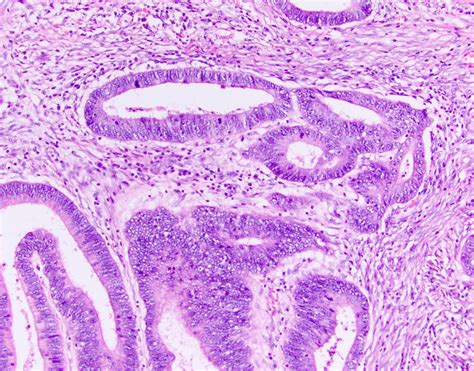 melanoma colon pathology outlines