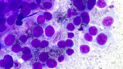 melanoma cytology pathology outlines