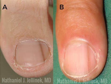 melanoma in fingernail pictures