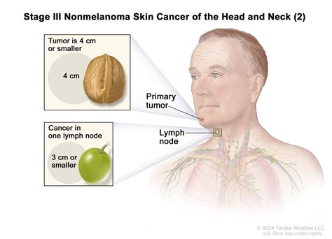 melanoma in neck lymph nodes prognosis