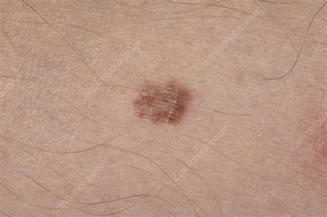 melanoma in situ bad pil