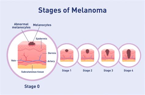 melanoma in situ diagram