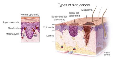 melanoma in situ mayo clinic