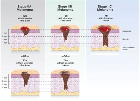 melanoma in situ stage 2