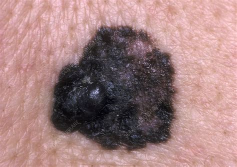 melanoma invasivo a diffusione superficiale