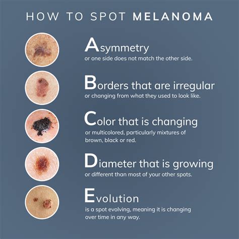 melanoma know more about diagnosis