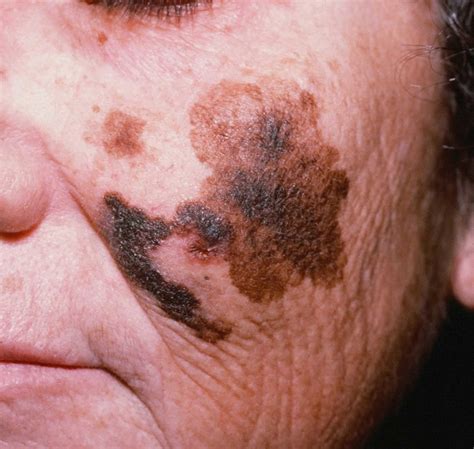 melanoma lentigo maligno causas