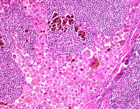 melanoma lymph node metastasis