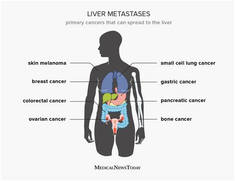 melanoma metastasis to liver symptoms