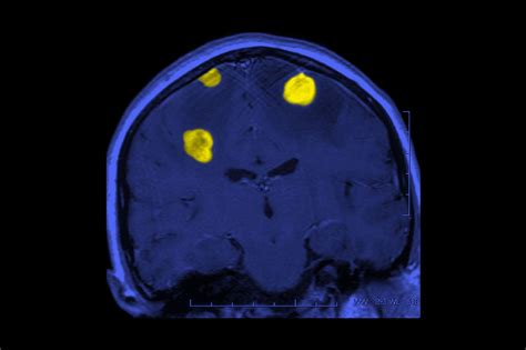 melanoma metastasized to brain prognosis