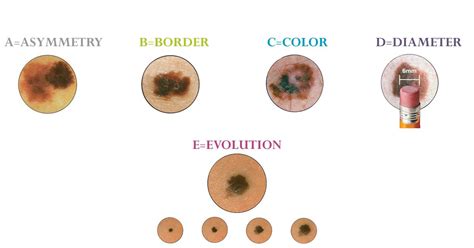 melanoma mole stages