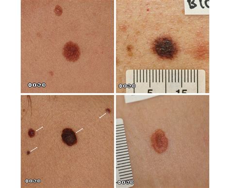 melanoma moles early stages