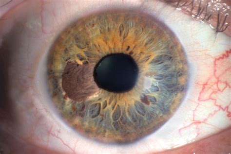 melanoma of eye symptoms