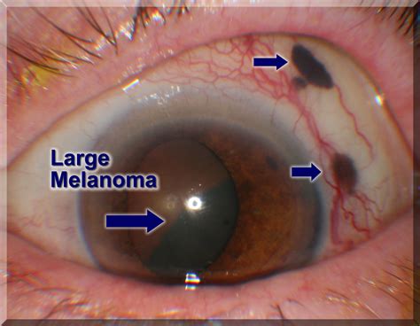 melanoma of the eye pictures