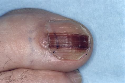 melanoma of the nail