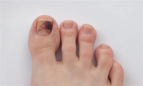 melanoma of the toenail image