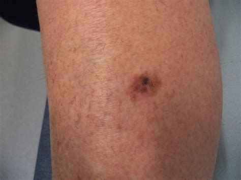 melanoma on the leg