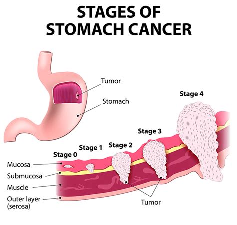 melanoma pictures on stomach