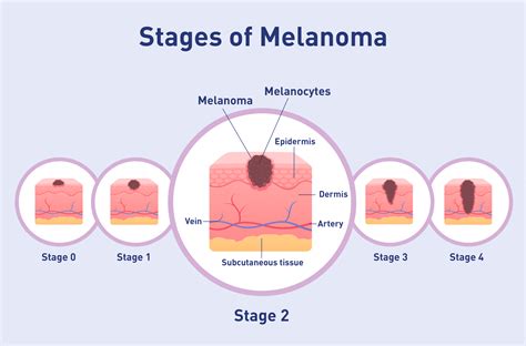 melanoma pictures stage 2