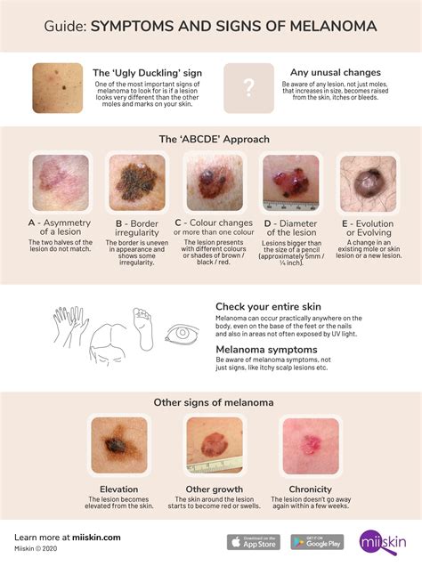 melanoma signs and symptoms