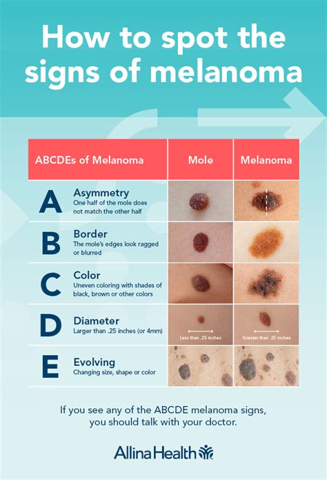 melanoma signs and symptoms pictures