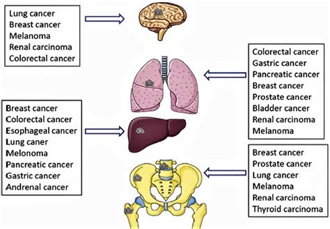 melanoma sites of metastasis