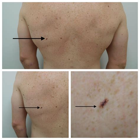 melanoma skin cancer on back