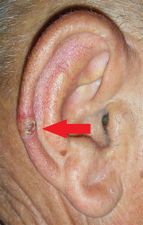 melanoma skin cancer on ear