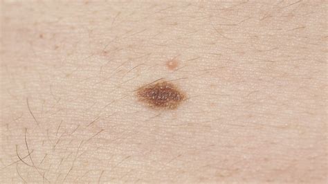 melanoma skin cancer spots