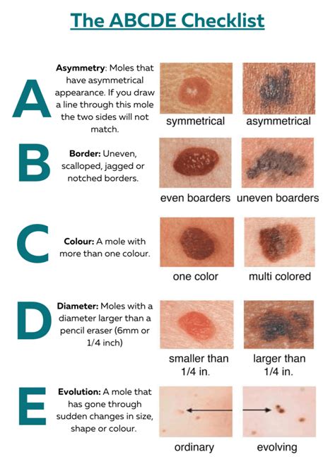 melanoma skin check frequency
