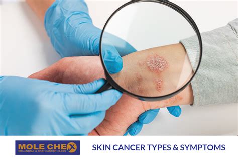 melanoma skin treatment