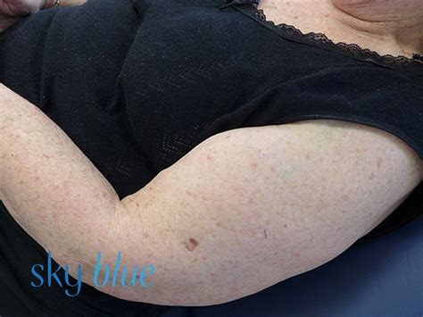 melanoma spot on arm