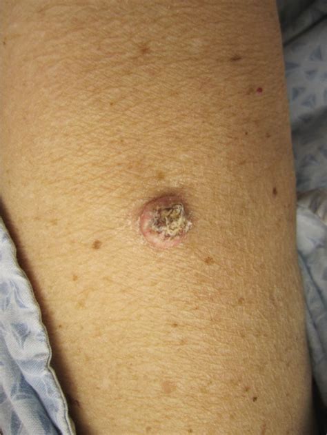 melanoma spots on arm