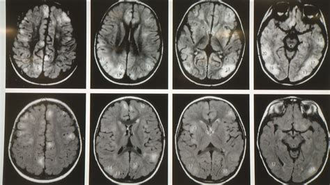 melanoma spread to brain