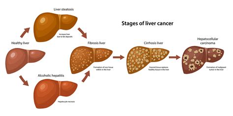 melanoma spread to liver prognosis